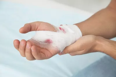 Stikkskade kuttskade